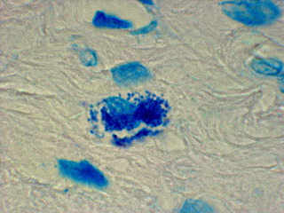 Acid-Fast Bacteria Discovered in Prostate Cancer